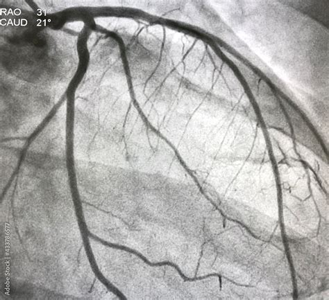 Coronary angiogram 